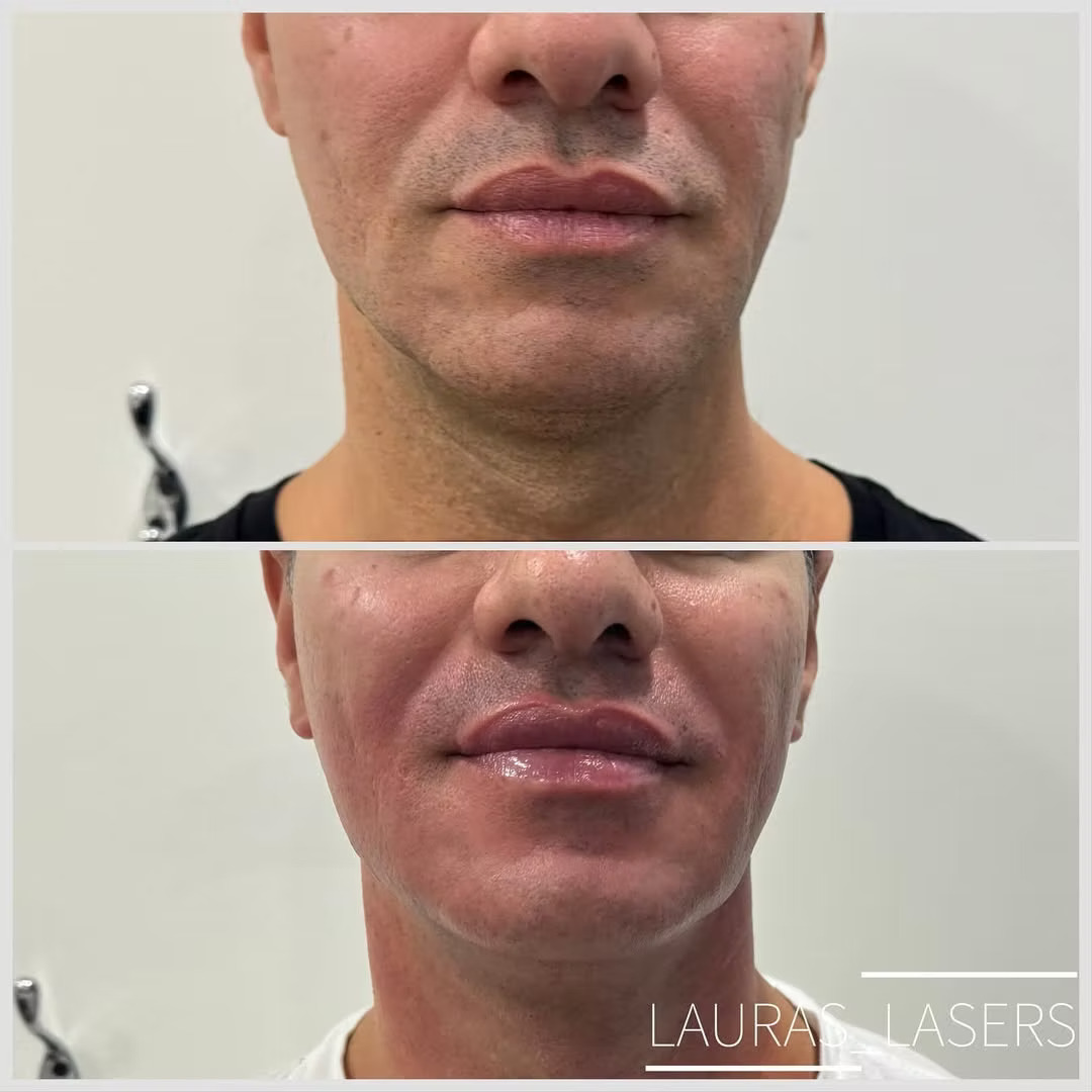 Skin tightening before and after, lower face, Calgary