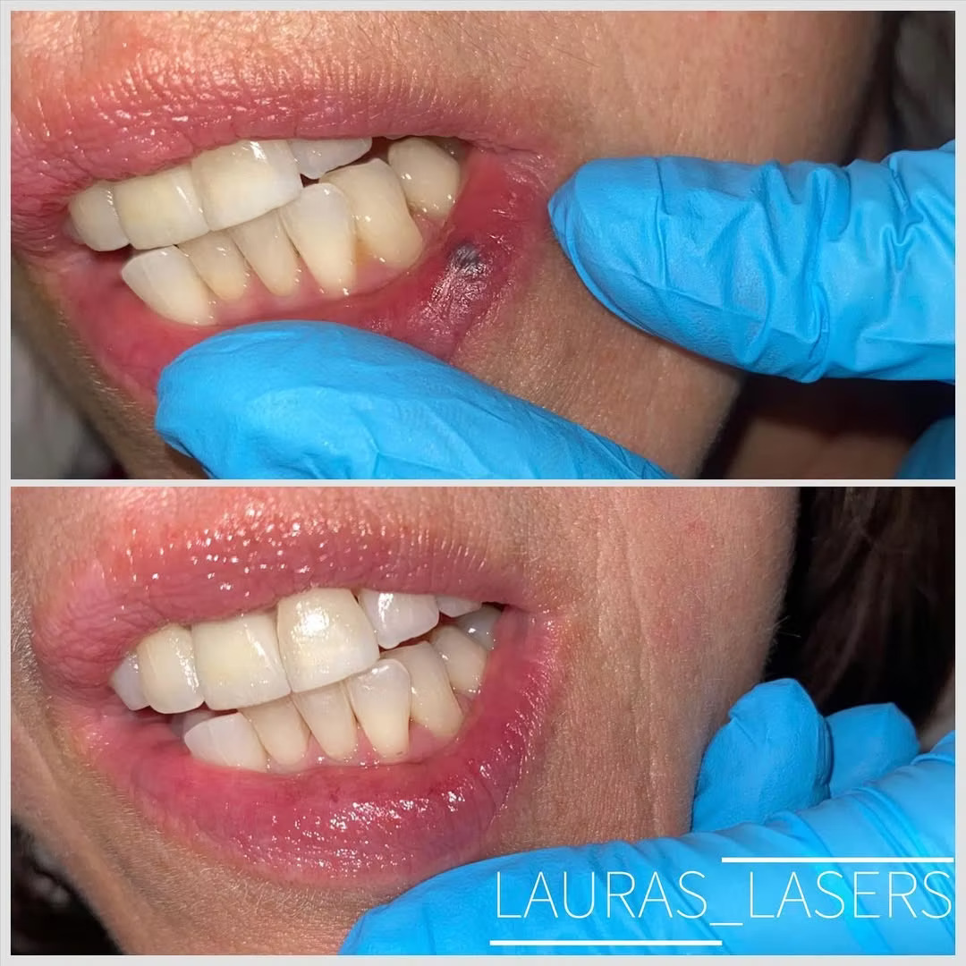 Mole and lesion removal before and after, lip, Calgary