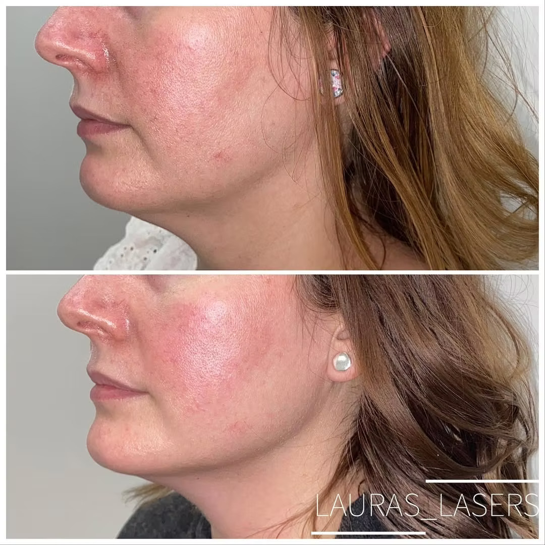 Skin tightening before and after, cheek, Calgary