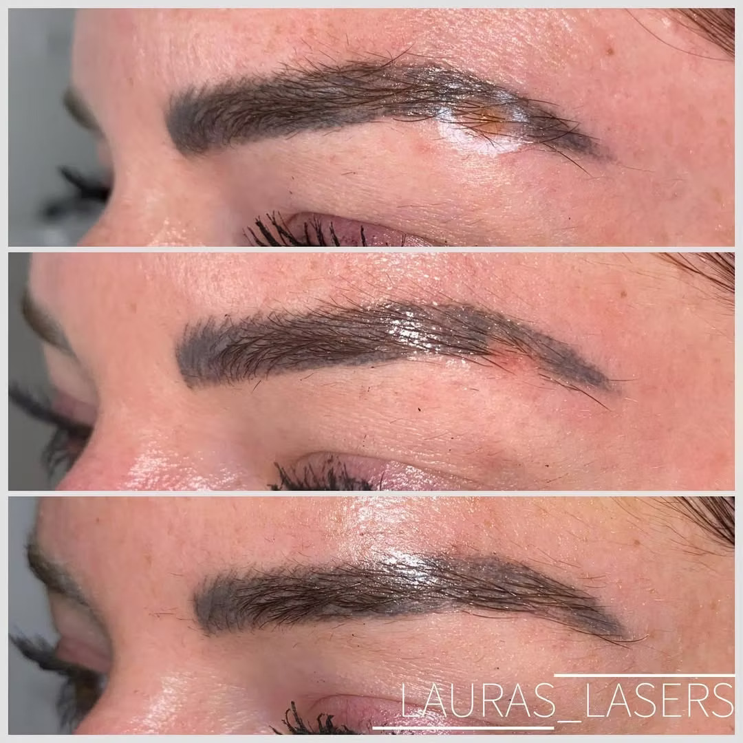 Mole and lesion removal before and after, eyebrow, Calgary