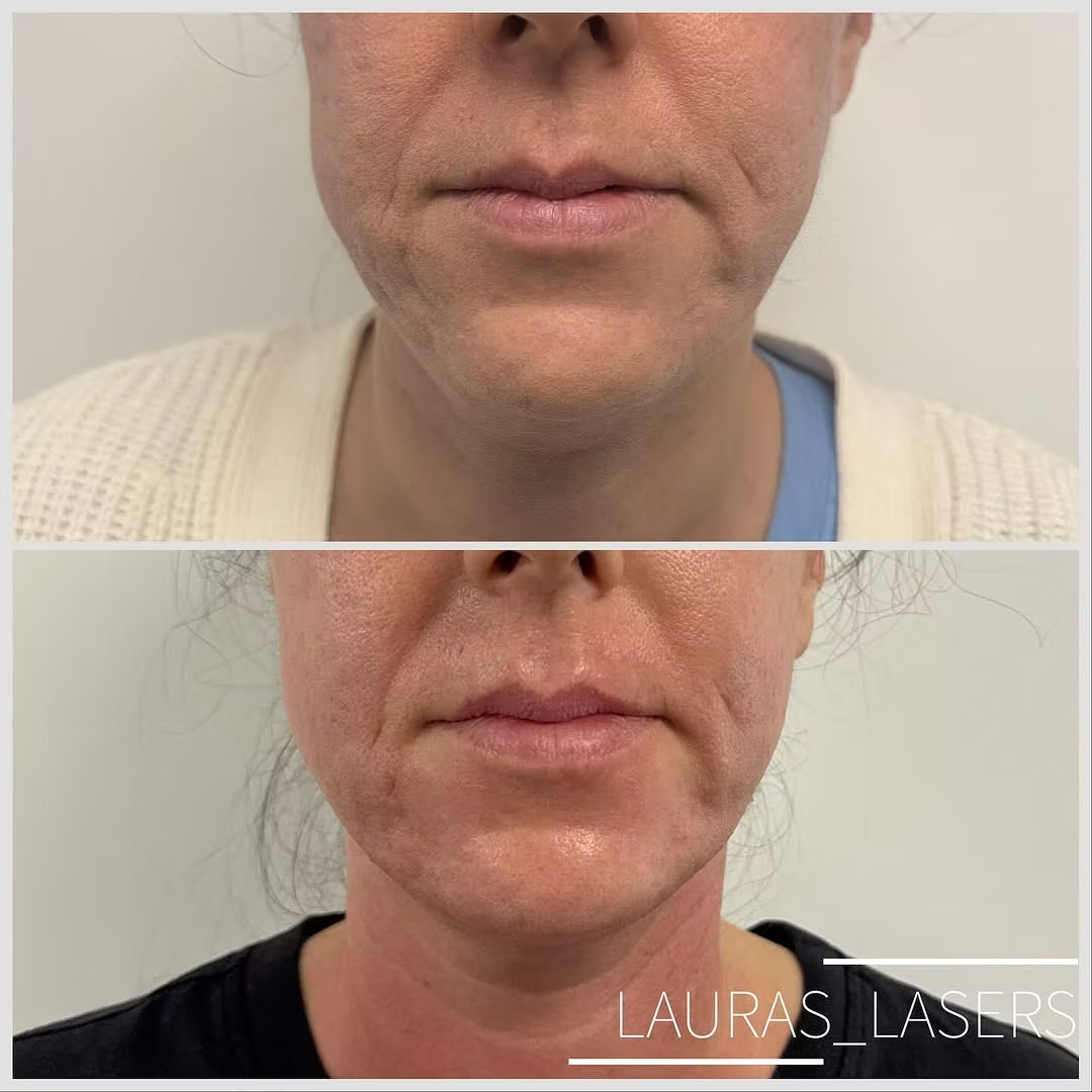 Skin tightening before and after, lower face and mouth area, Calgary