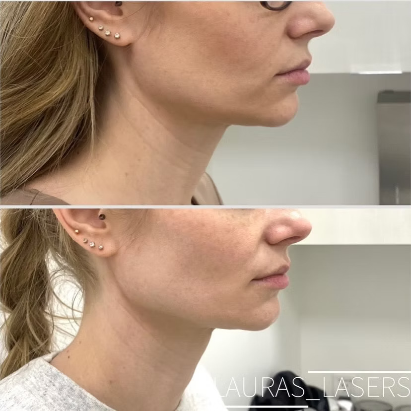 Skin tightening before and after, jawline, Calgary