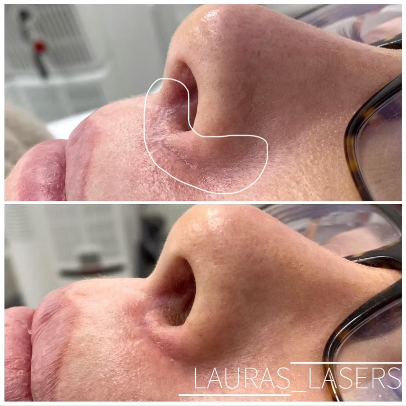 Laser scar revision before and after, nose, Calgary