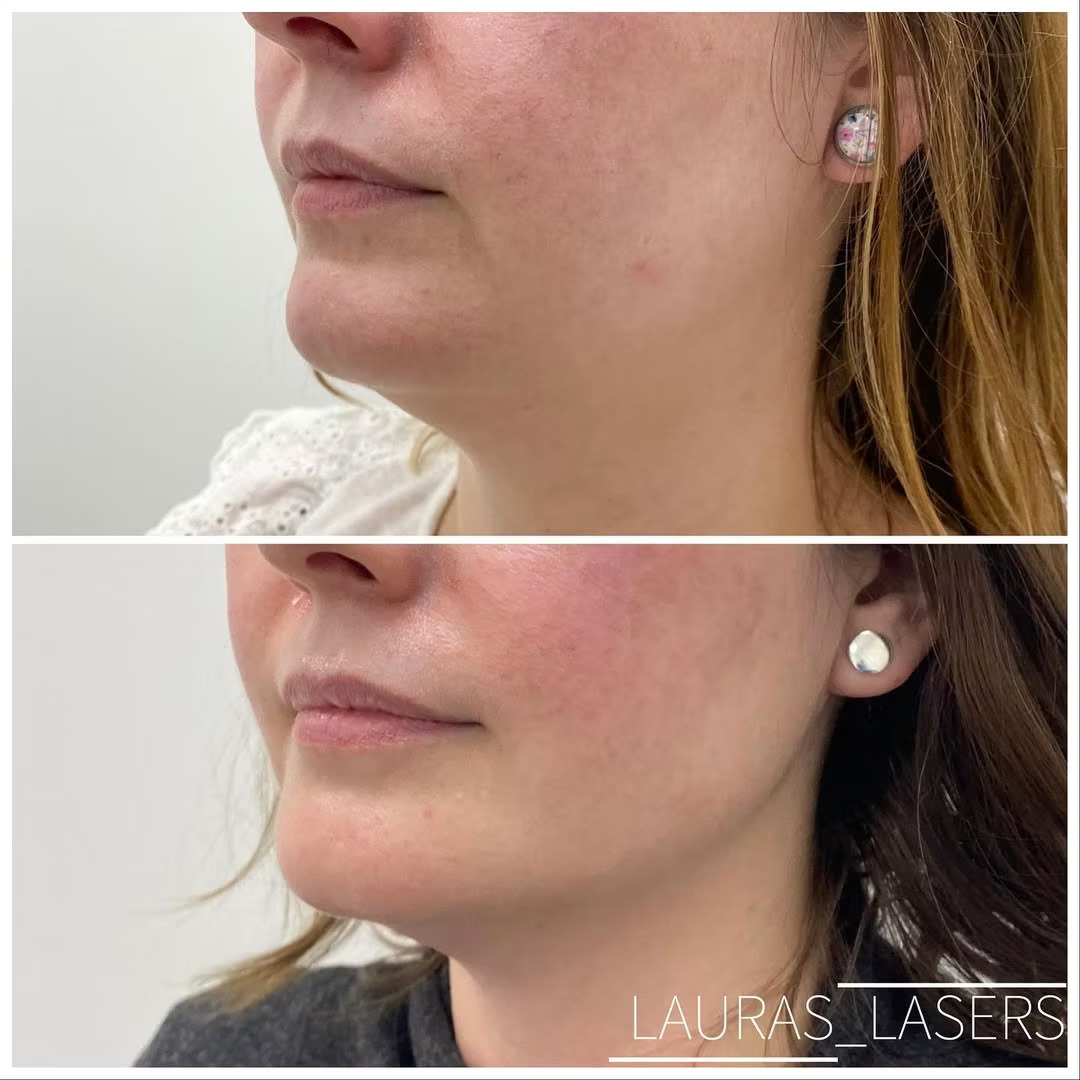 Skin tightening before and after, jawline, Calgary