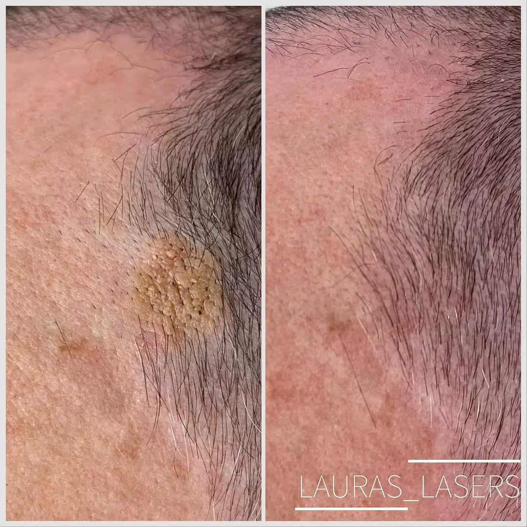 Mole and lesion removal before and after, scalp, Calgary