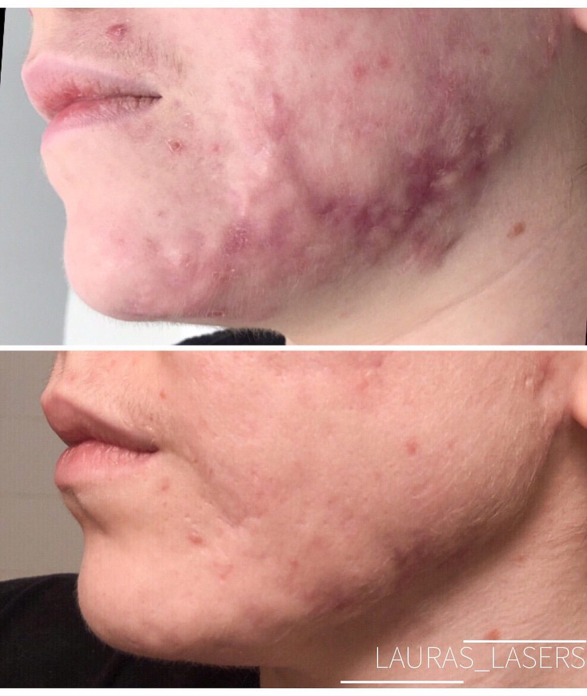 Laser scar revision before and after, acne scarring, Calgary
