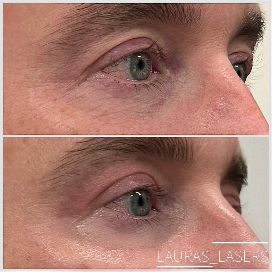 Laser blepharoplasty before and after, eye area close-up, male patient, Calgary