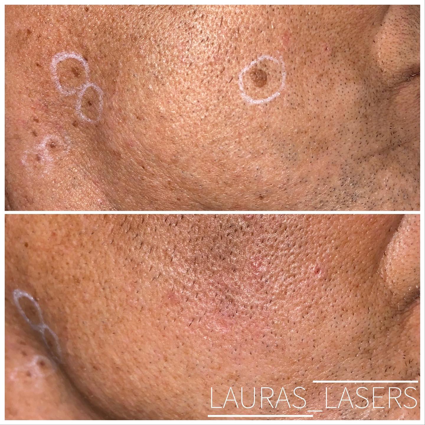 Mole and lesion removal before and after, cheek, Calgary