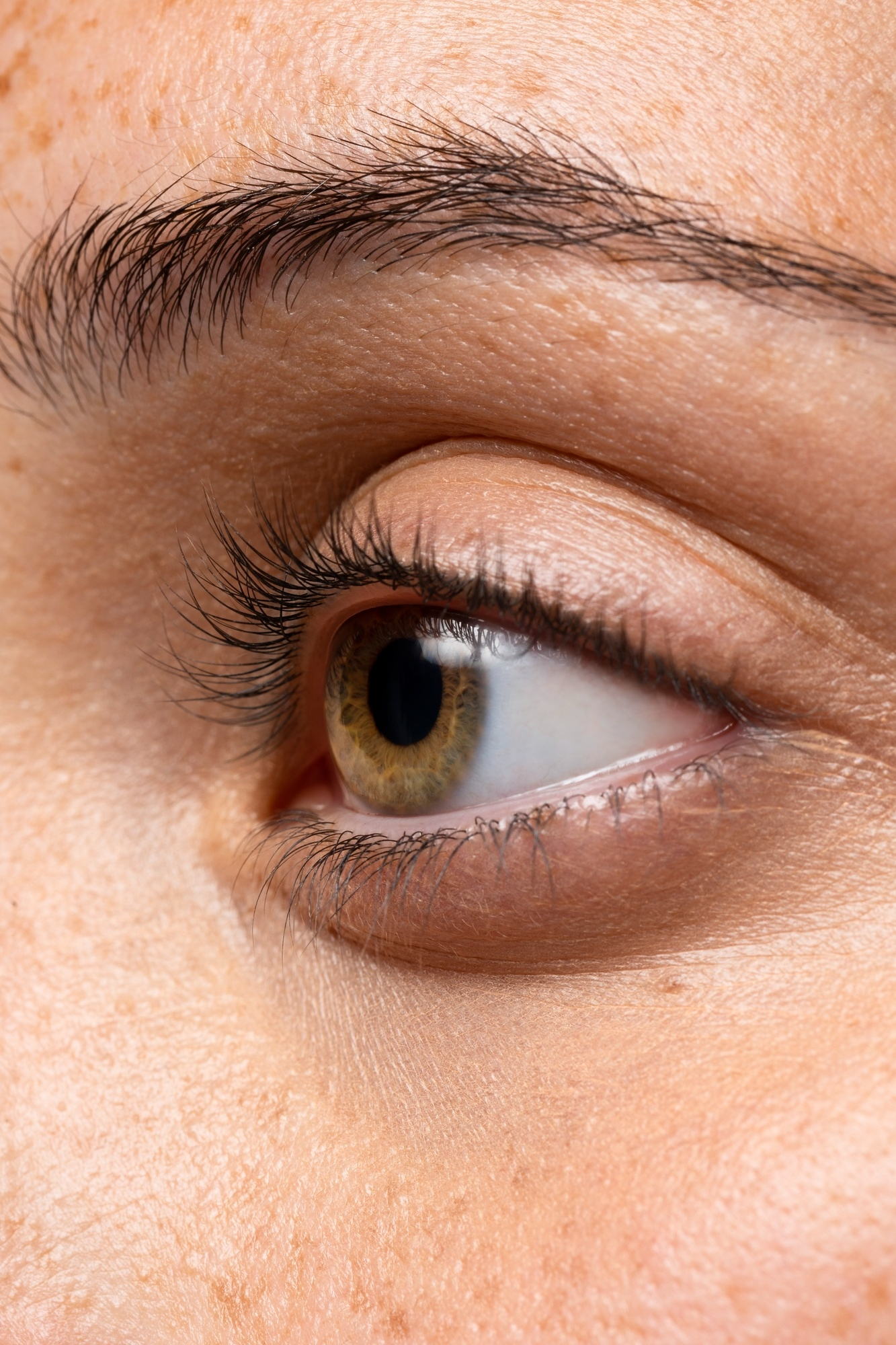 Laser Blepharoplasty in Calgary